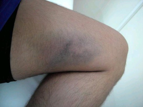 body bruise